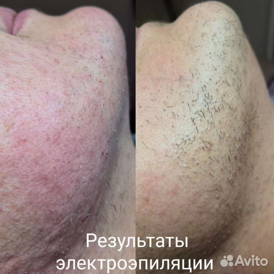 Электроэпиляция/Воск