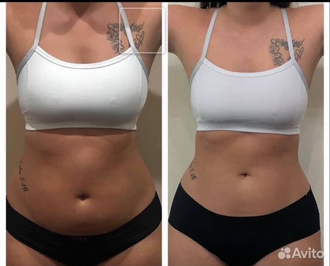 Антицеллюлитный массаж vela shape / пр Просвещения