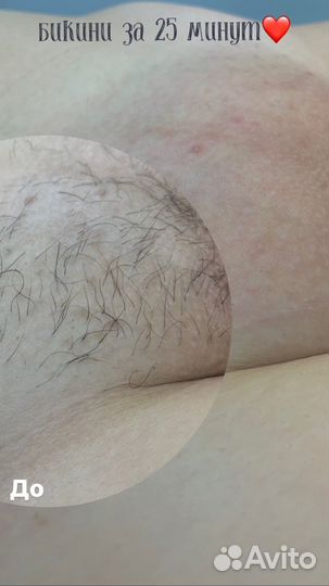 Шугаринг женский депиляция