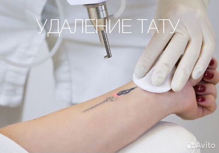 Удаление лазером тату