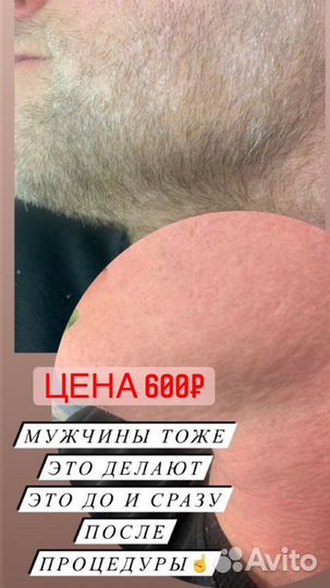 Шугаринг депиляция