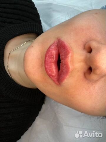 Контурная пластика ботокс губы косметолог объявление продам