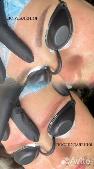 Неодимовый лазер для удаления тату