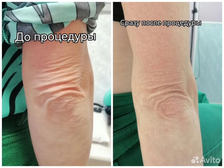 Омоложение лица