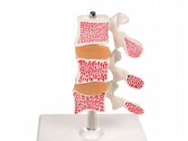 Анатомическая модель остеопороза