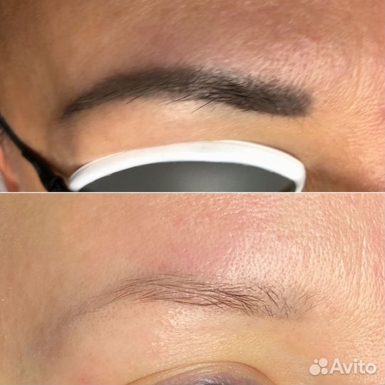 Удаление тату и татуажа