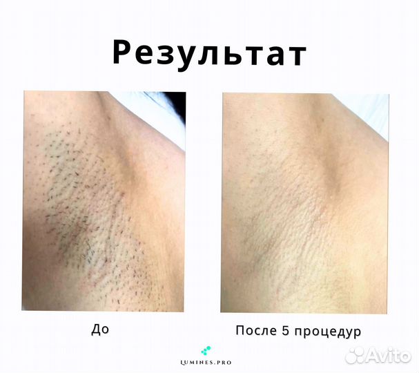 Диодный лазер Lumines-M Макс Ван 1200в