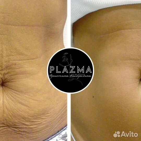 Удаление рубцов и растяжек(стрии)