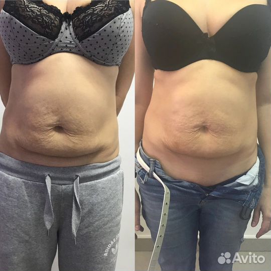 Emsculpt коррекция фигуры