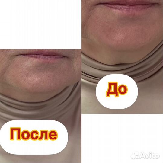 СМАС лица и тела