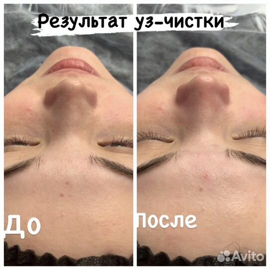 Косметология, Шугаринг