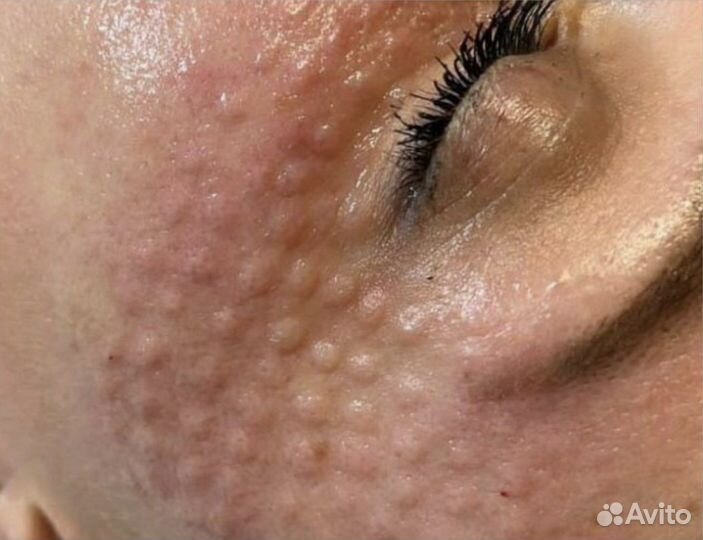 Мезотерапия