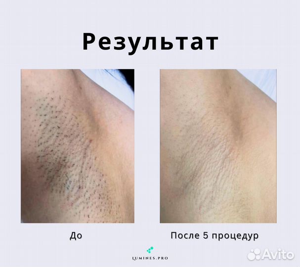 Диодный лазер для эпиляции lumines Макс’Ван 1200