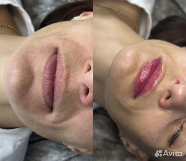Контурная пластика губ