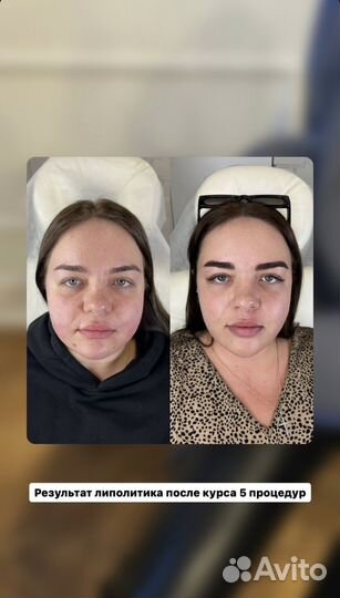 Косметолог худое лицо липолитики