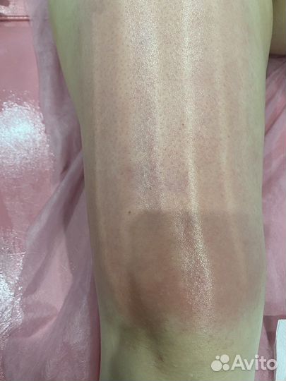 Обучение ручной липосакции