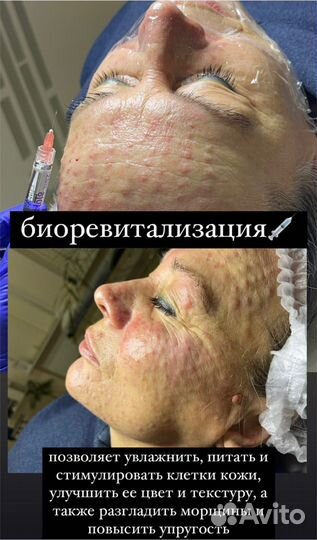 Увеличение губ, ботокс, мезотерапия