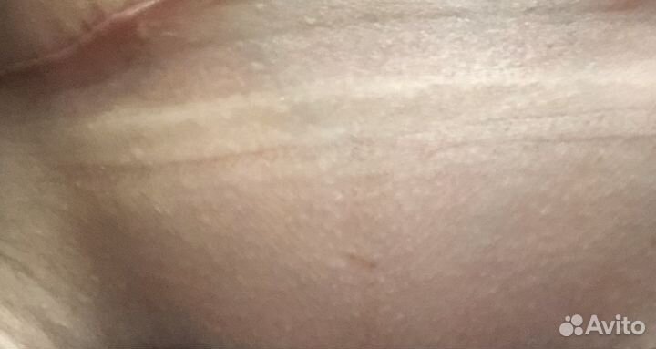 Электроэпиляция