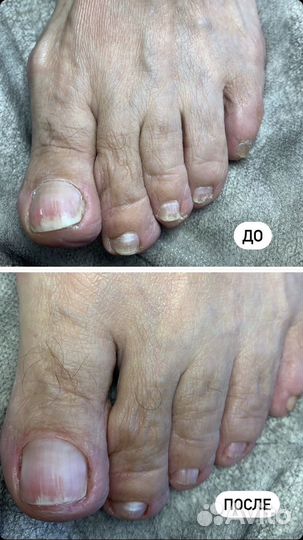 Медицинский педикюр подолог