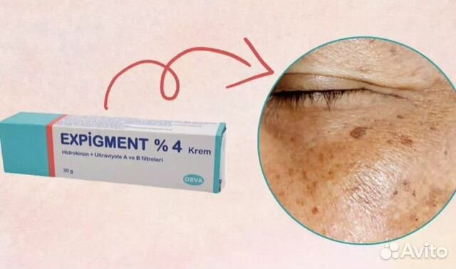 Экспигмент отзывы фото до и после Expigment отбеливающий крем Турция купить в Москве Личные вещи Авито