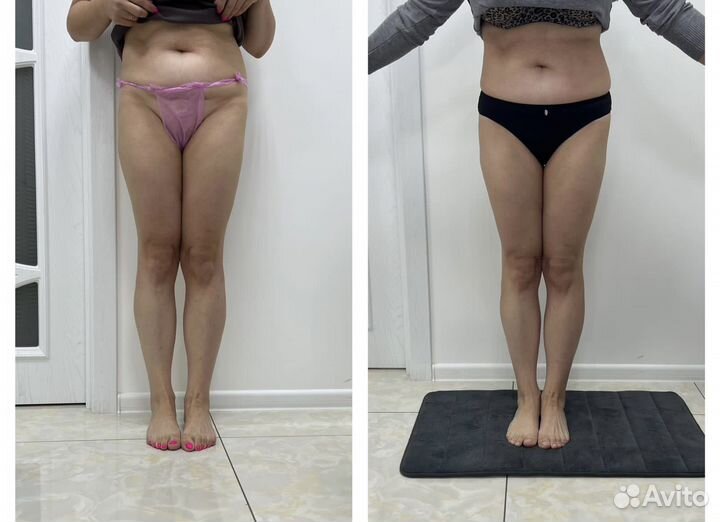 Аппаратный массаж (коррекция фигуры)