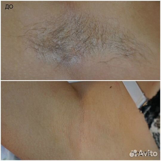 Spa-шугаринг