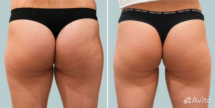 Модели на Криолиполиз Бедер