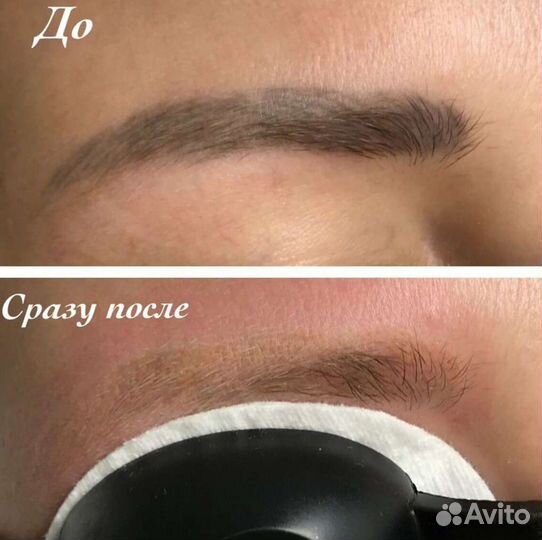 Удаление татуажа