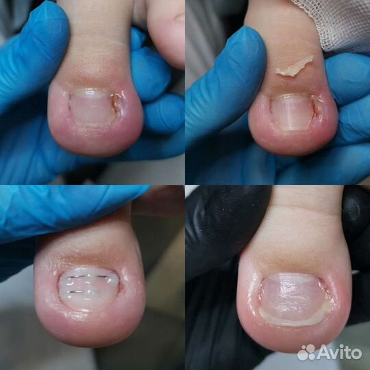 Подолог Бутово. Услуги подолога