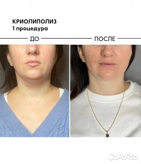 Криолиполиз подбородка