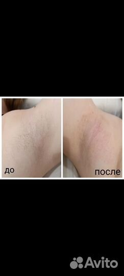 Восковая депиляция