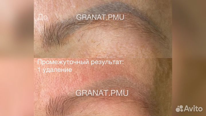 Лазерное удаление перманента и татуажа бровей