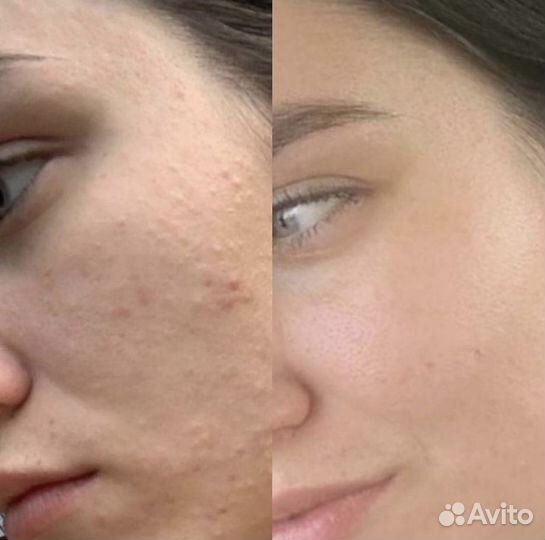 Косметолог Пилинг лица