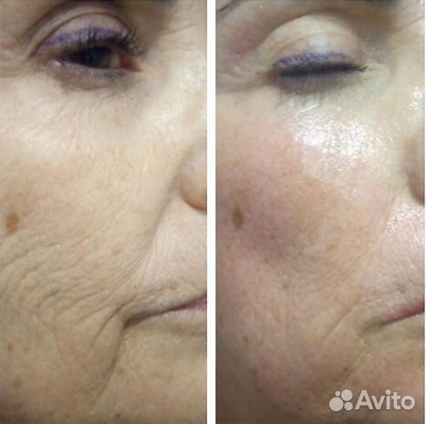 Аппаратная косметология