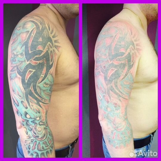 Удаление татуировок и перманентного макияжа