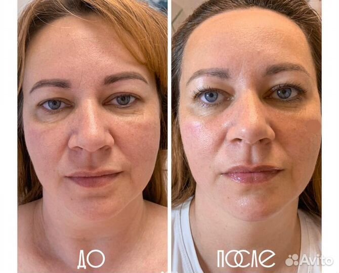 Скульптурный массаж лица + карбокситерапия