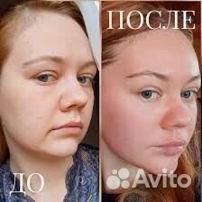 Нужны модели /Пластический массаж лица/ Лифтинг