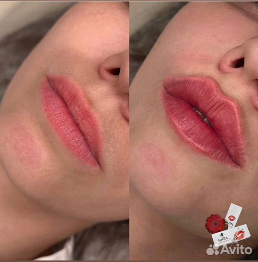 Увеличение губ