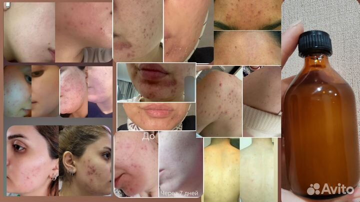 Лосьон для прыщей, угревой сыпи, акне