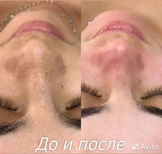Чистка лица модель
