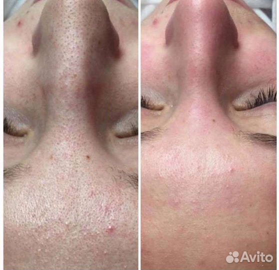 Дарсонвализация