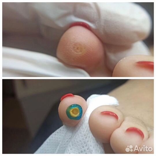 Удаление бородавок СПб