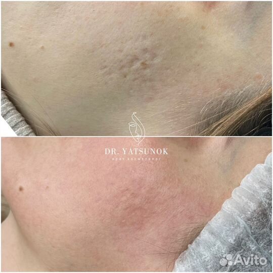 Лазерная шлифовка с охлаждением