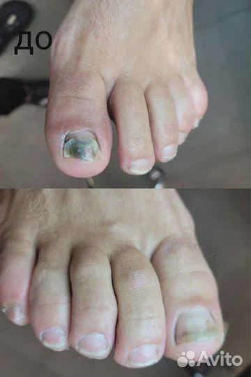 Медицинский педикюр / Подология