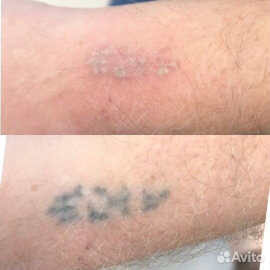 Удаление татуажа лазером