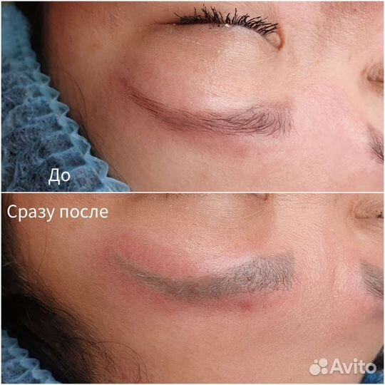 Лазерное удаление татуажа