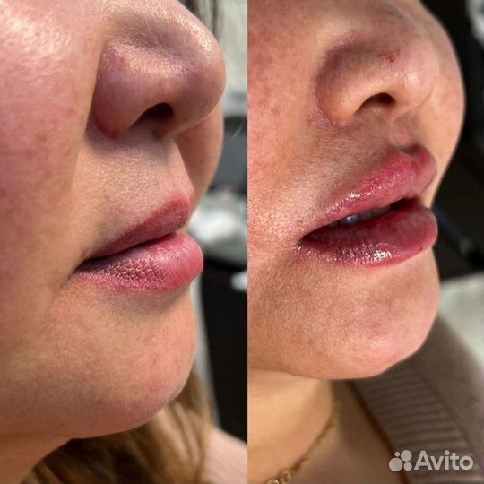 Уколы красоты