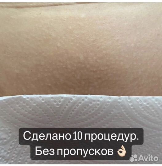 Лазерная эпиляция