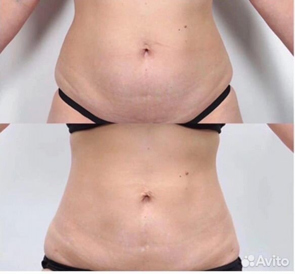 Кавитация, Биофотон, Вакуумный массаж, Шугаринг