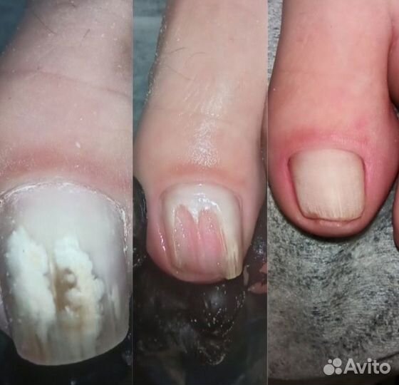 Подолог Педикюр